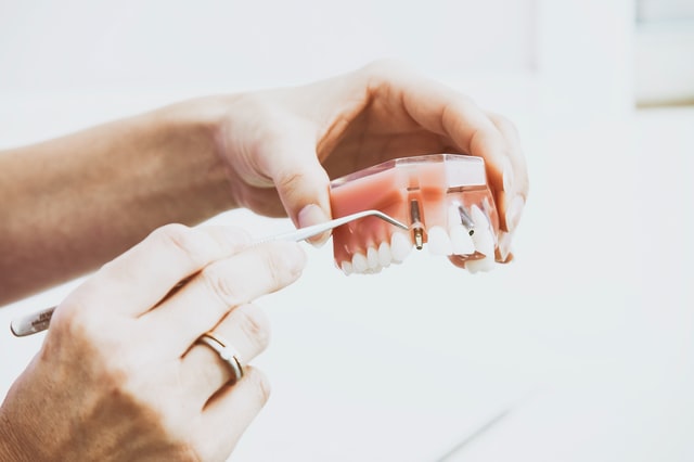 Quels sont les risques à encourir avec les implants dentaires ?