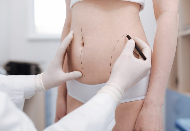 À quels dangers s’exposent les femmes qui ont subi une liposuccion ?