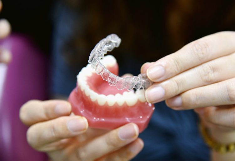 La plaque occlusale dentaire : comment ça fonctionne ?  