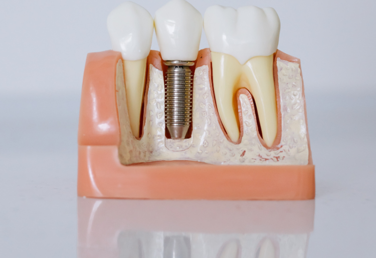 Les implants dentaires : une alternative durable aux prothèses dentaires traditionnelles