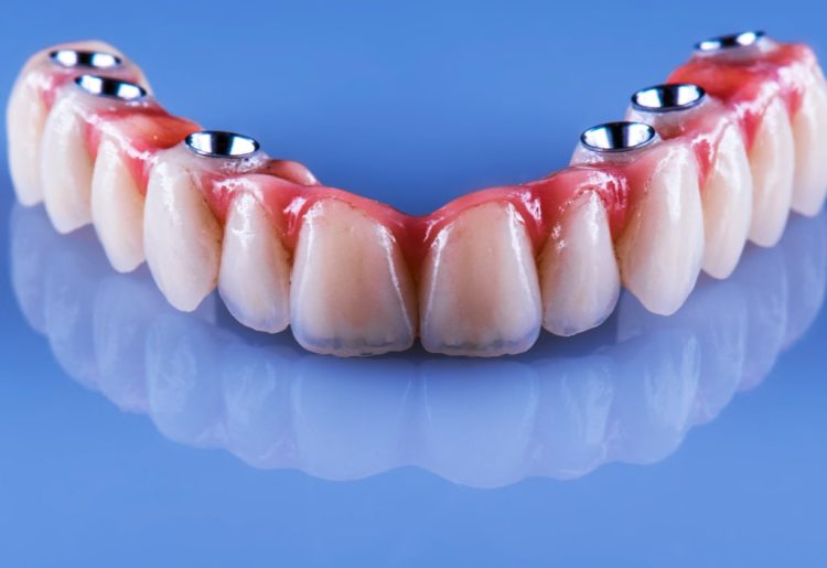 Astuces pour trouver la prothèse dentaire idéale
